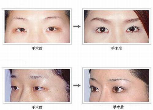 韩式三点双眼皮手术过程(图)